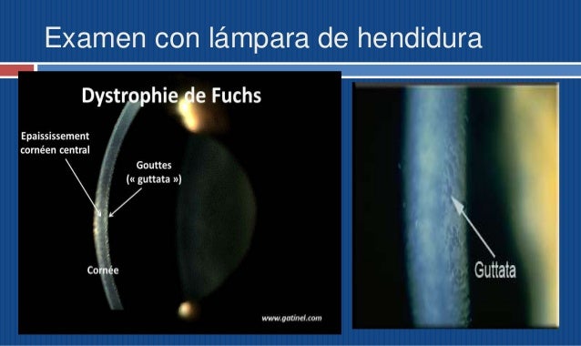 distrofia endotelial de fuchs